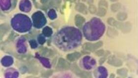 应对流行性出血热，“三早一就”很重要